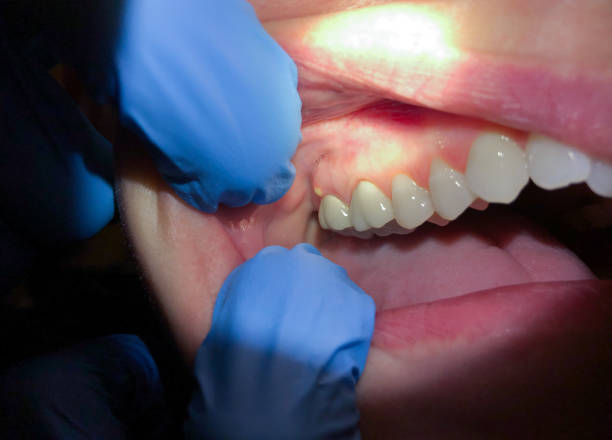 Best Emergency Tooth Extraction in South Whitley, IN