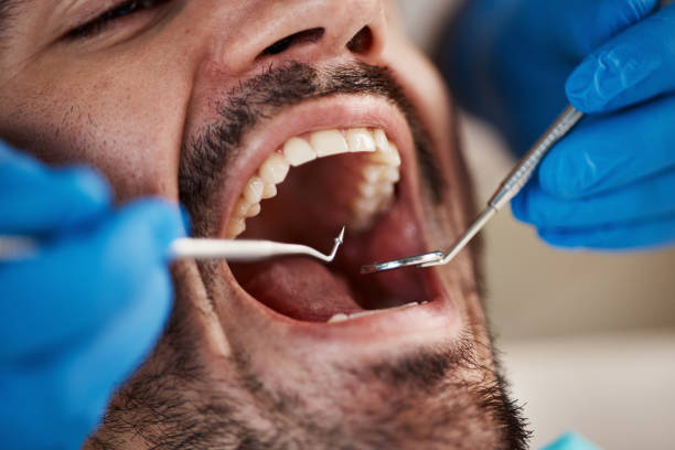 Best Emergency Wisdom Teeth Removal in South Whitley, IN